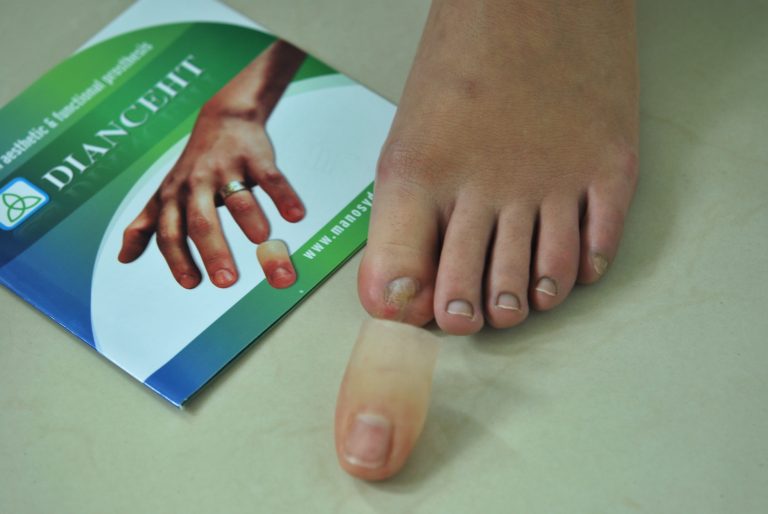 prosthetic toe finger
