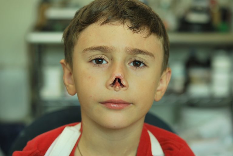 prosthetic nose