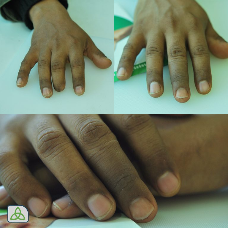 middle finger prostheses