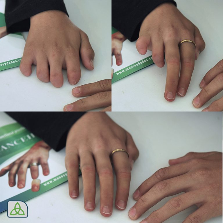prosthetic fingers