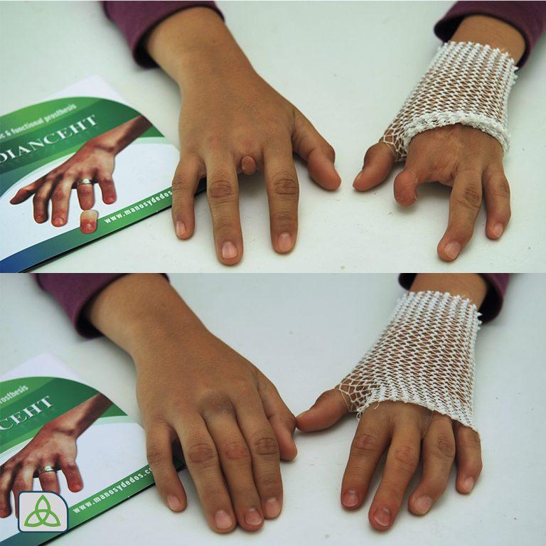 prosthetic middle finger