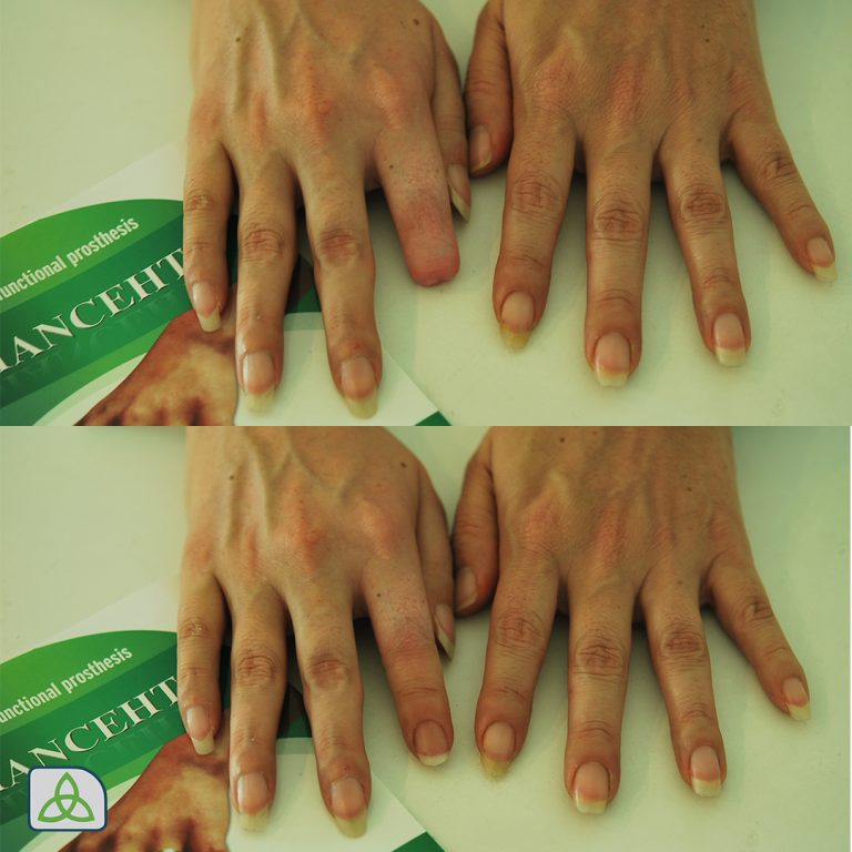 prosthetic index finger