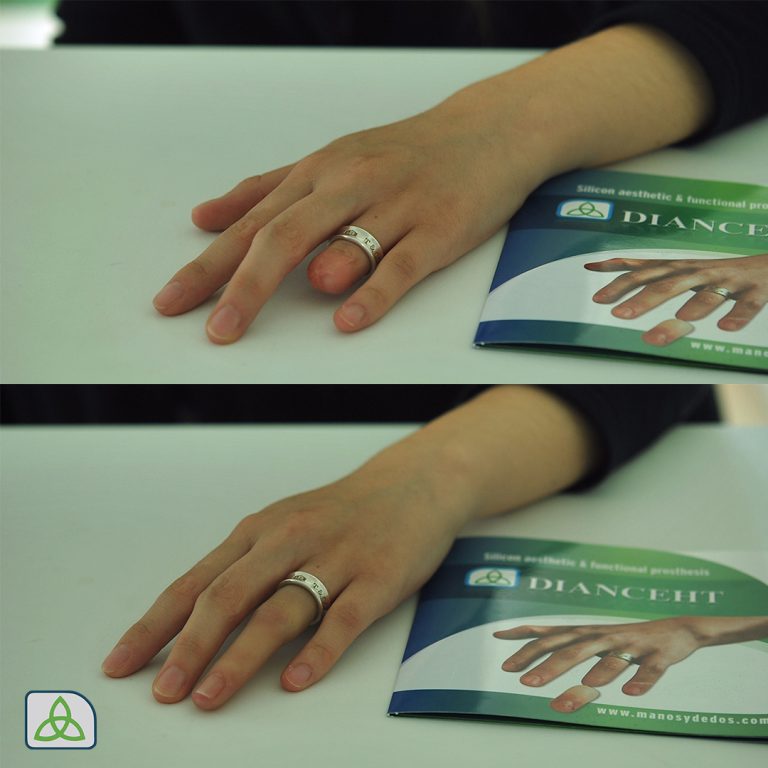 finger prosthesis