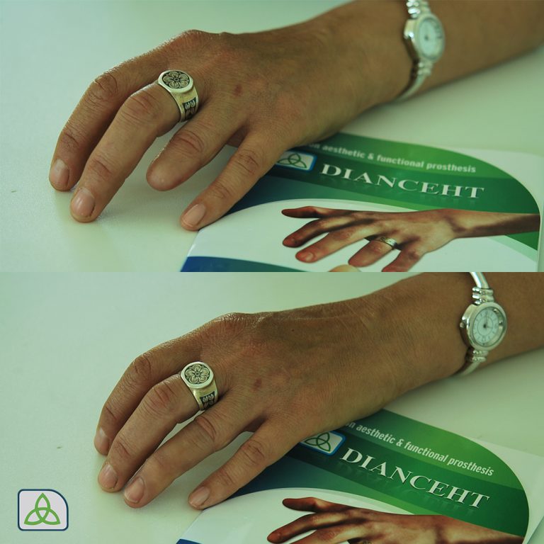 prosthetic ring finger