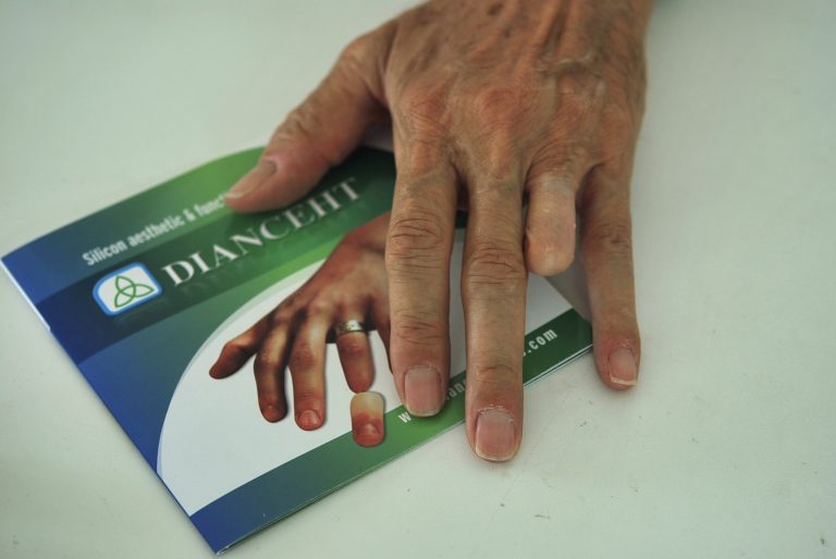 ring finger prosthesis