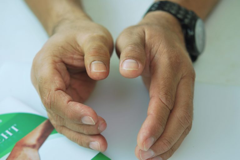 prosthetic thumb