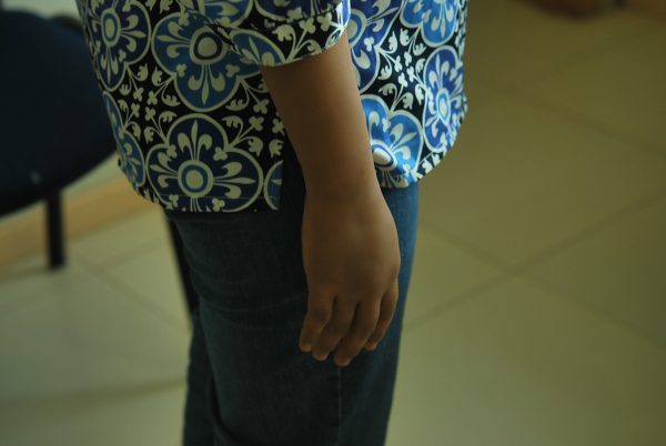 right prosthetic arm woman