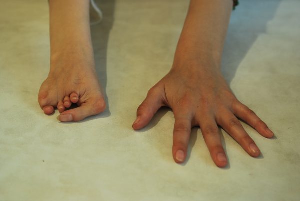 hand prosthetics