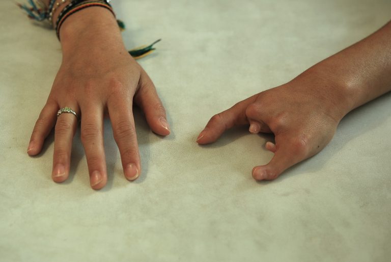 prosthetic hand