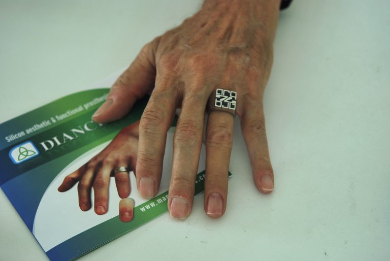 ring finger prostheses