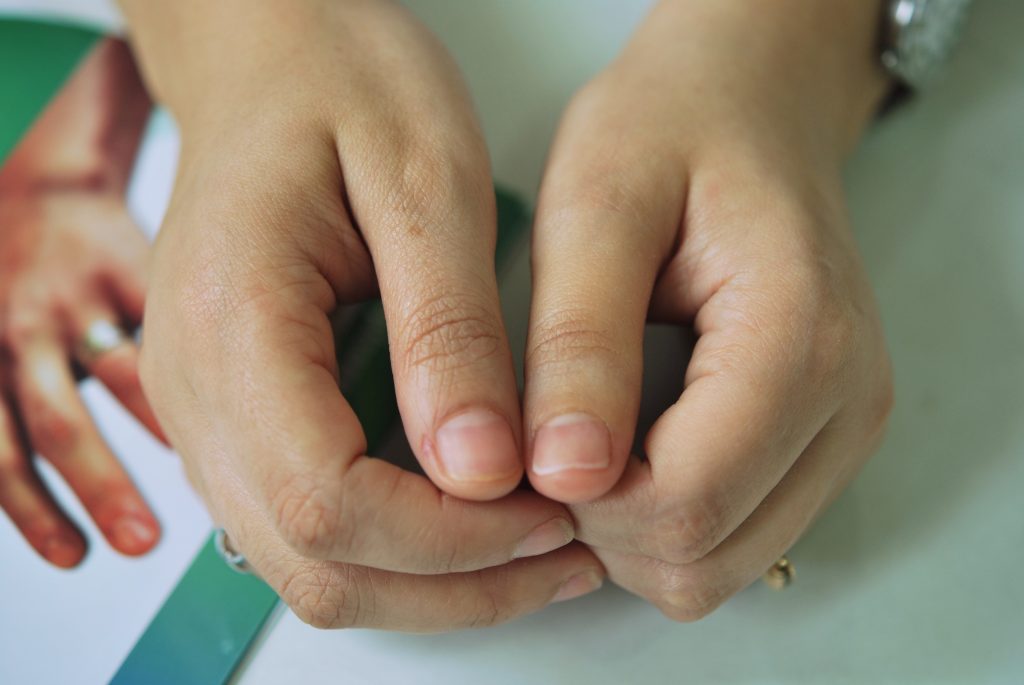 prosthetic thumb