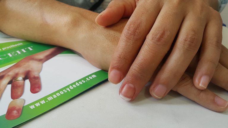 finger prosthesis