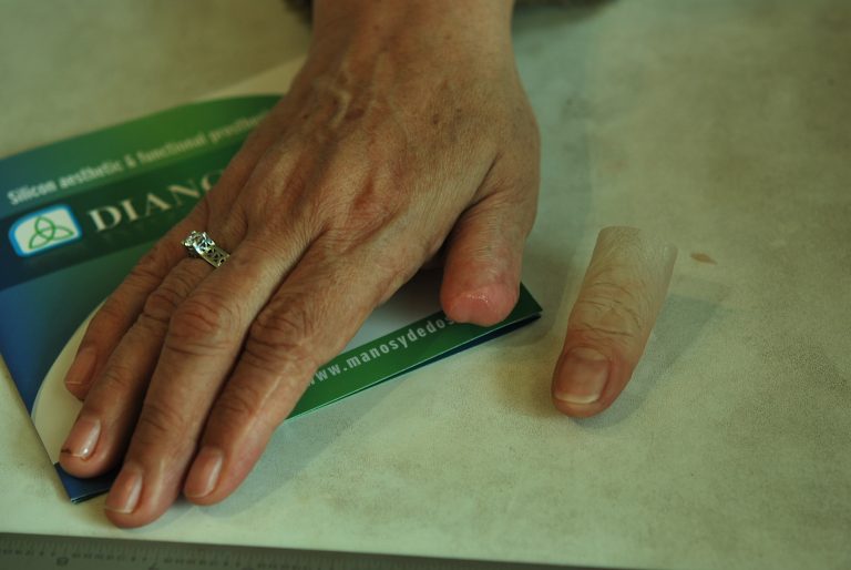 prosthetic thumb