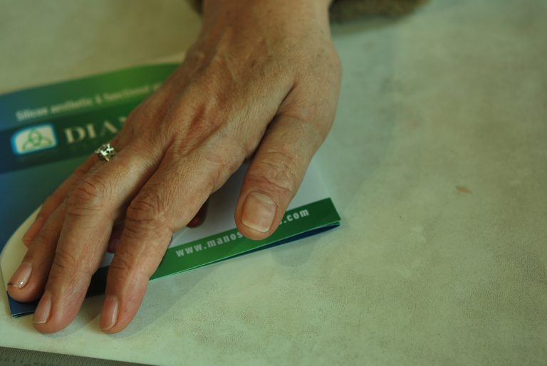 thumb prosthetics