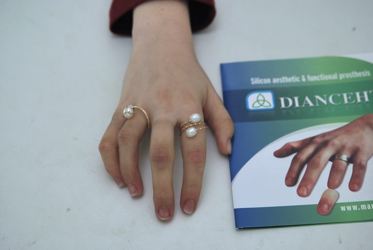 prosthetic fingers