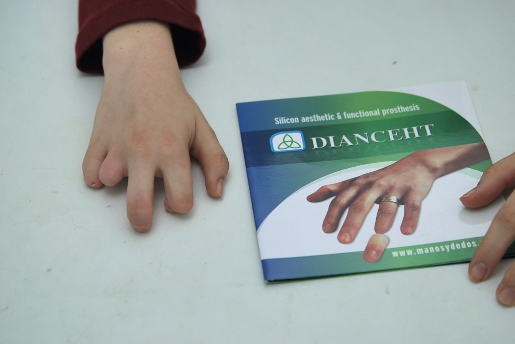 Finget Lab Prosthetic finger
