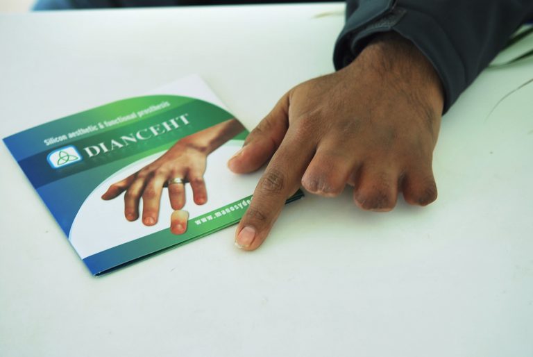 prosthetic fingers