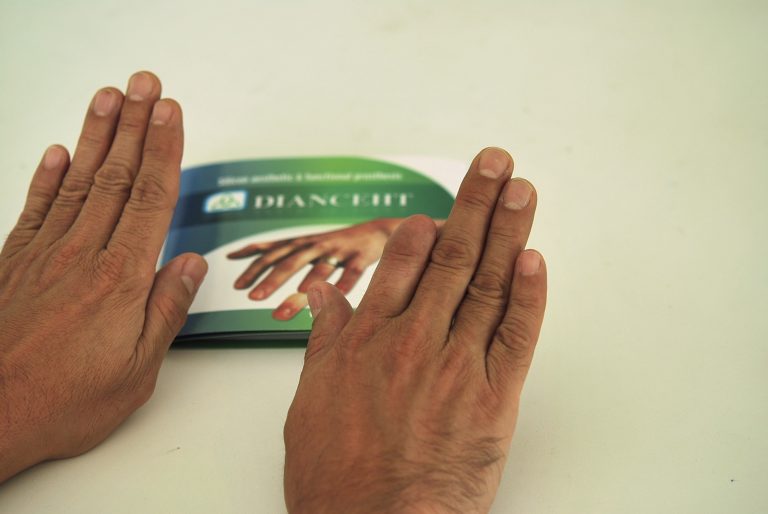 index finger prosthesis