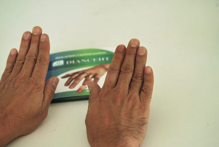 prosthetic index finger