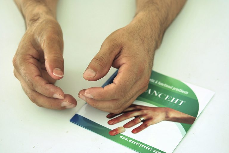 prosthetic fingers