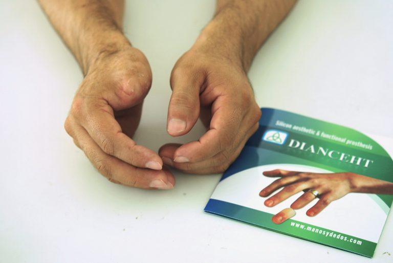 prosthetic finger