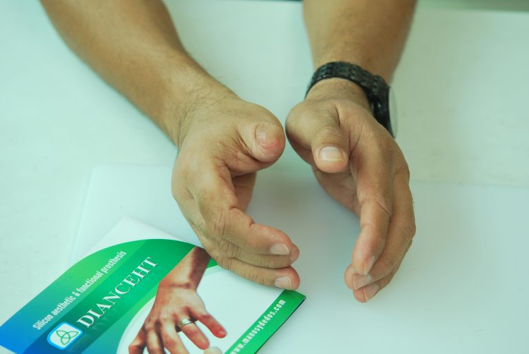 thumb prostheses