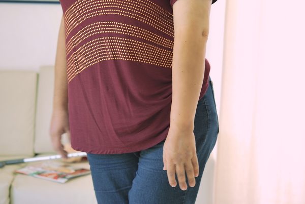 woman with a left prostheti arm