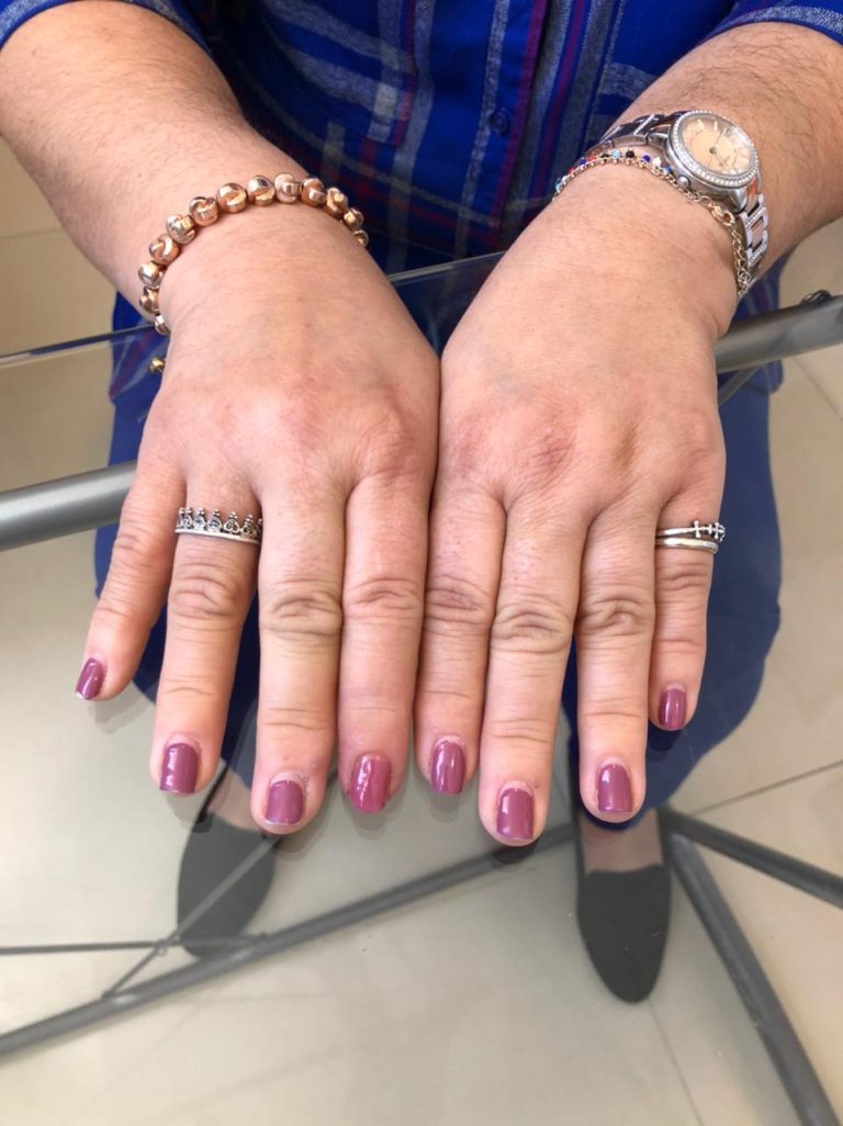 ring finger prosthesis