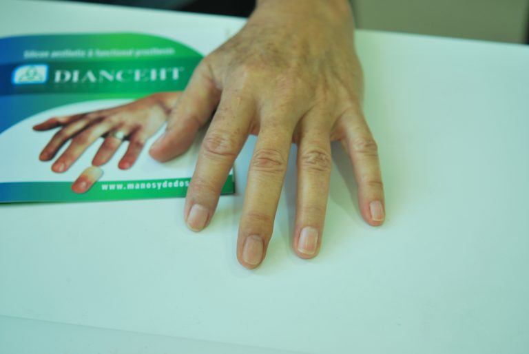 prosthetic middle finger