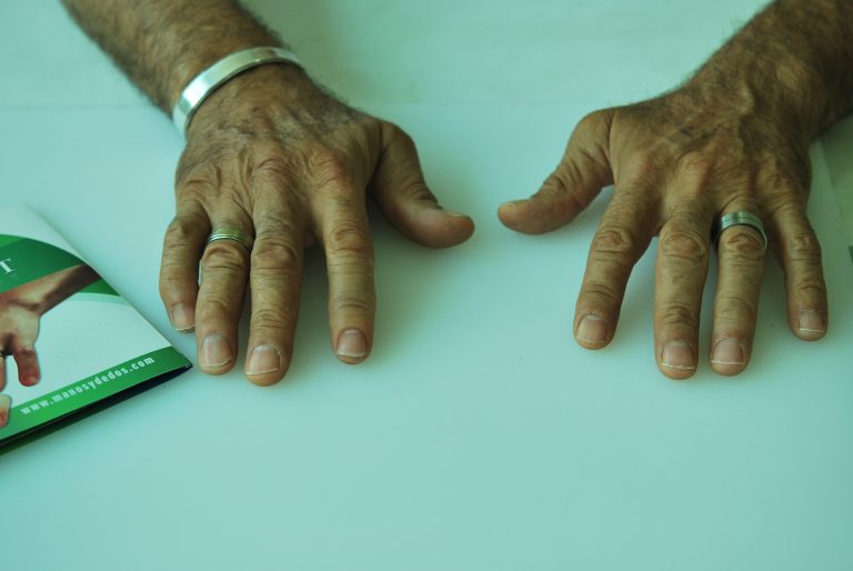 finger prosthetics