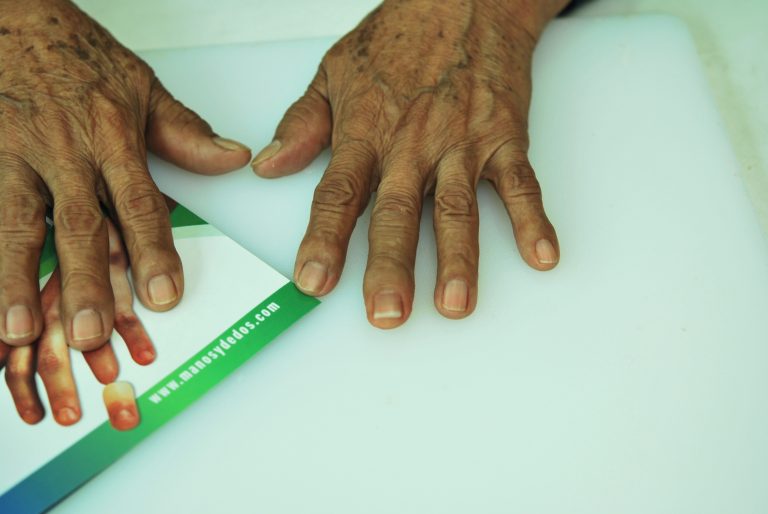 prosthetic finger