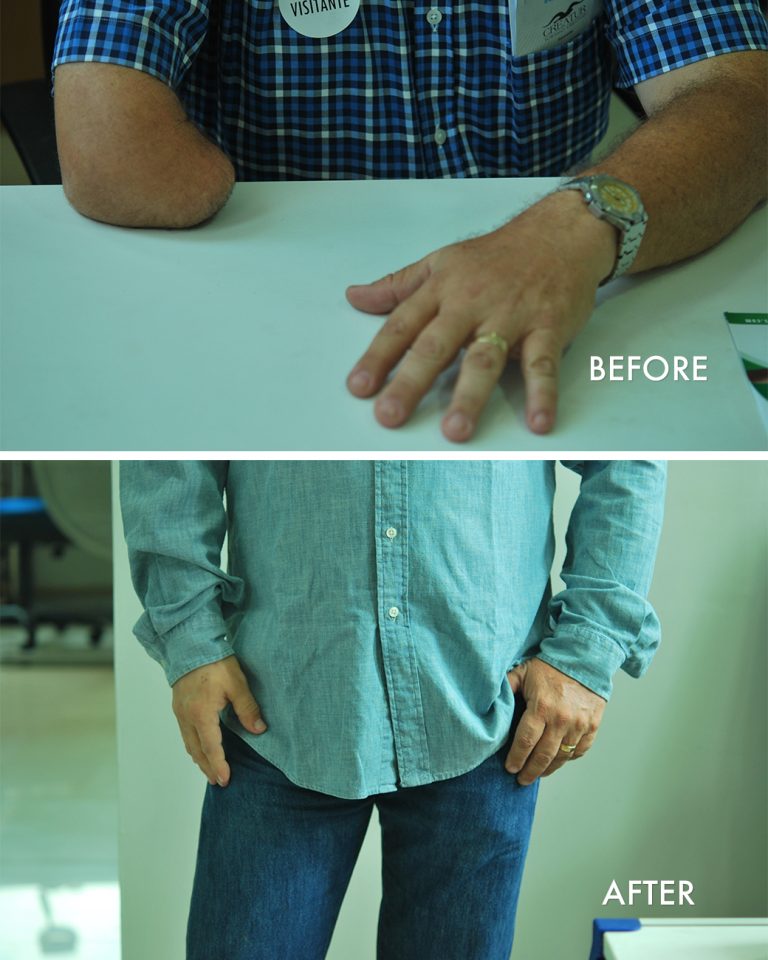 prosthetic arm