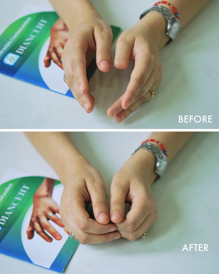 prosthetic thumb finger
