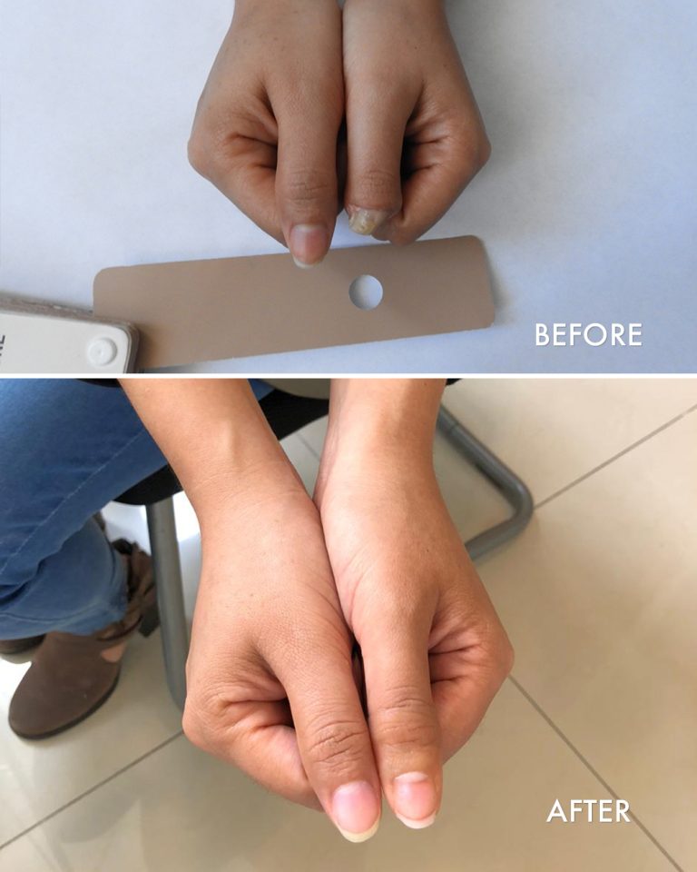 prosthetic thumb fingertip