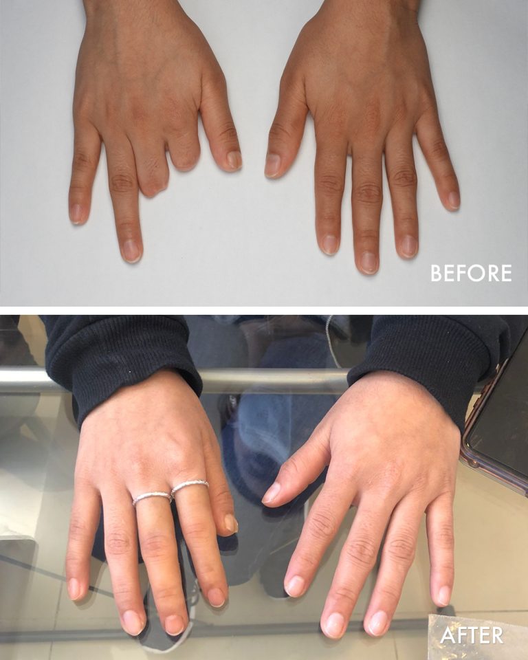 fingers prostheses