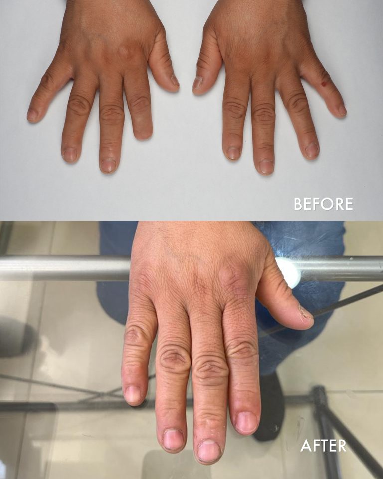prosthetic index finger