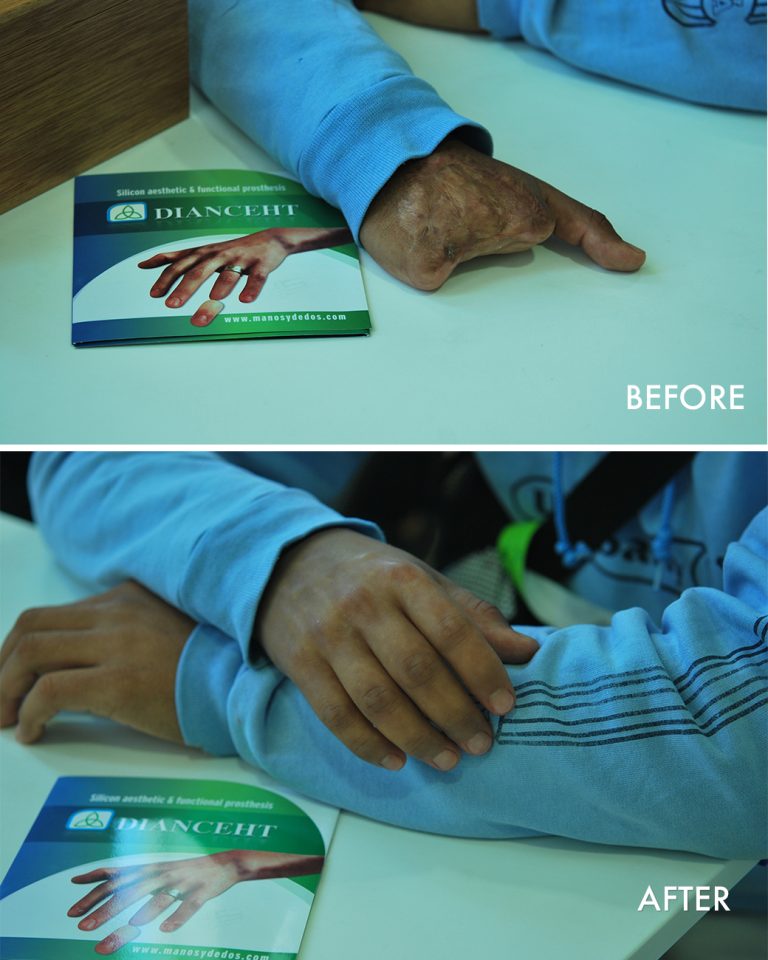 prosthetic hand