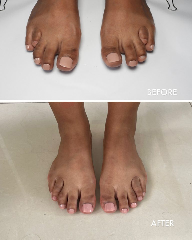 prosthetic toes