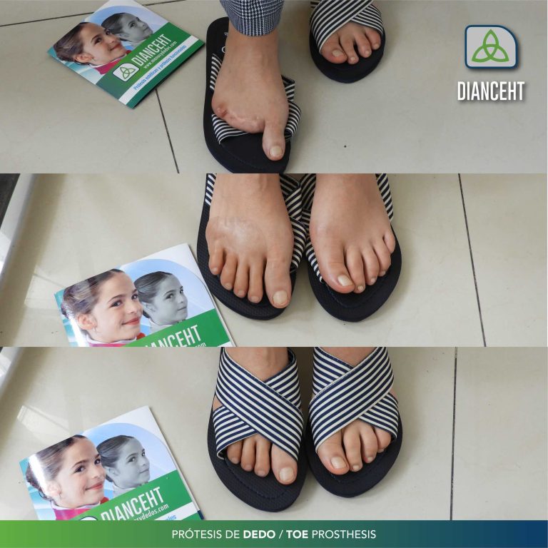 prosthetic toes