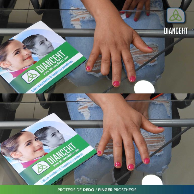 ring finger prosthetic