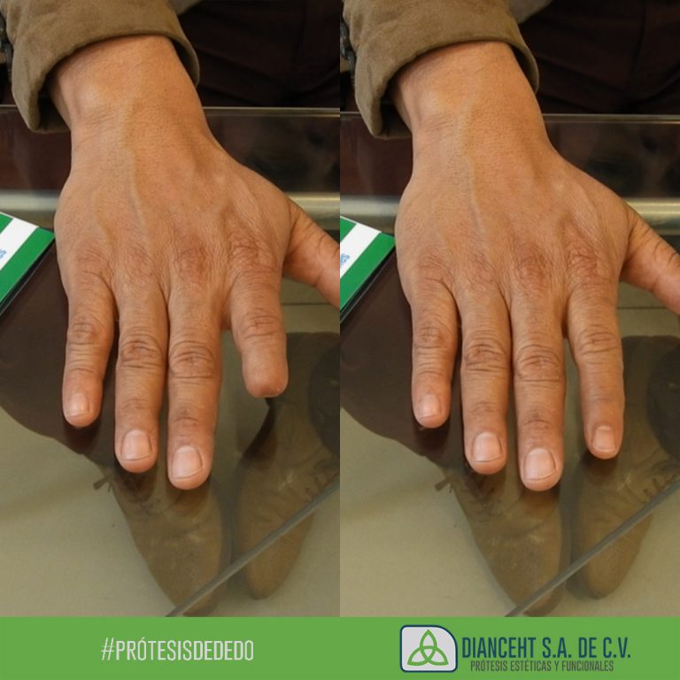 prosthetic index finger