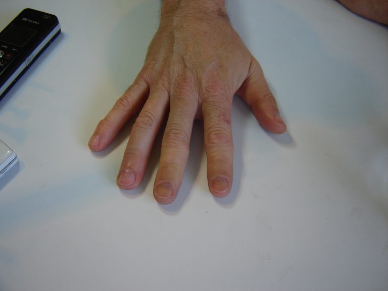 finger prosthetic