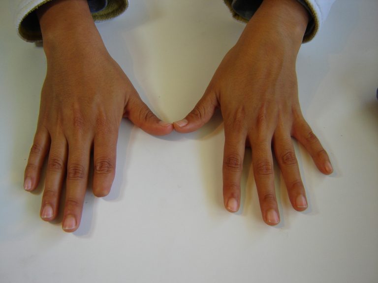prosthetic finger
