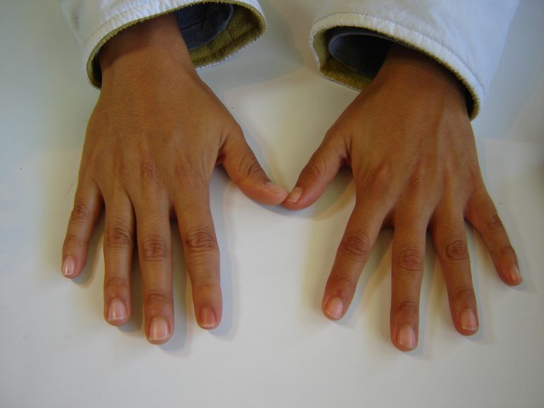 prosthetic finger