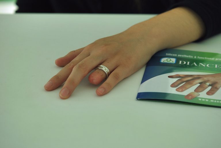 prosthetic fingers