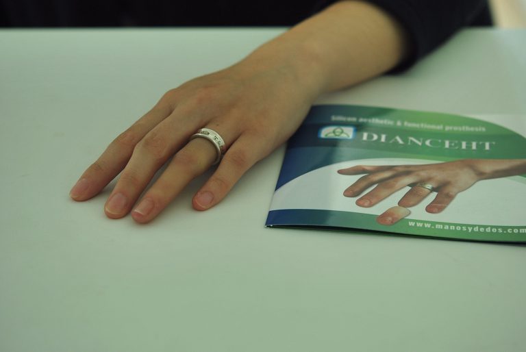ring finger prosthesis