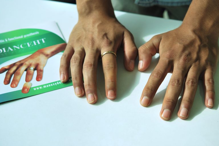 index finger prosthetic
