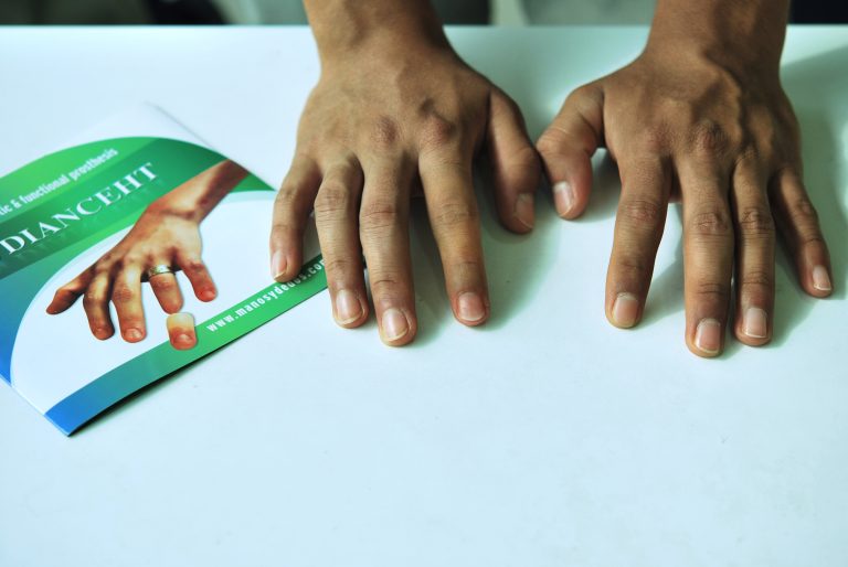 index finger prostheses