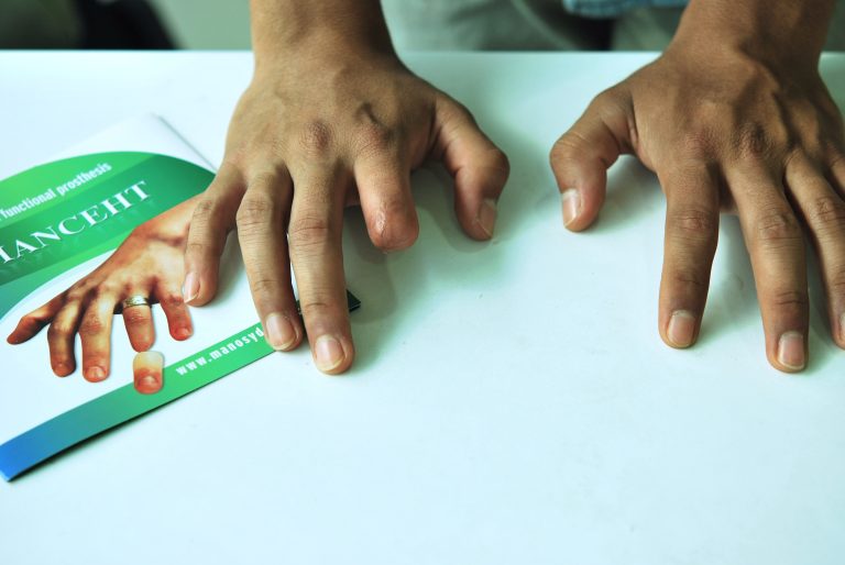 index finger prosthesis