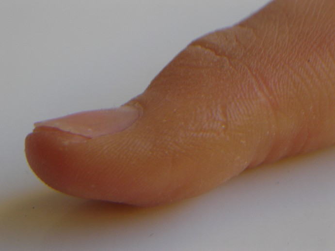 prosthetic thumb